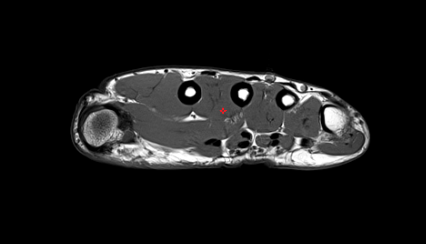 First plantar (palmar) interosseous muscle of hand of hand axial cross sectional anatomy 3T MRI AI enhanced radiology image-img-00000-00000_00001