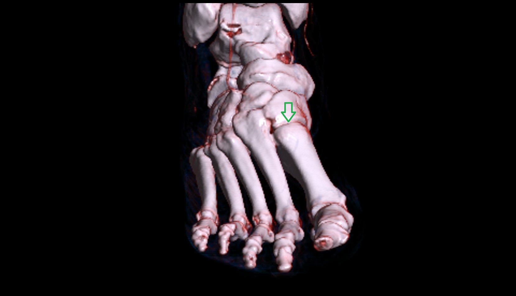First tarsometatarsal joints