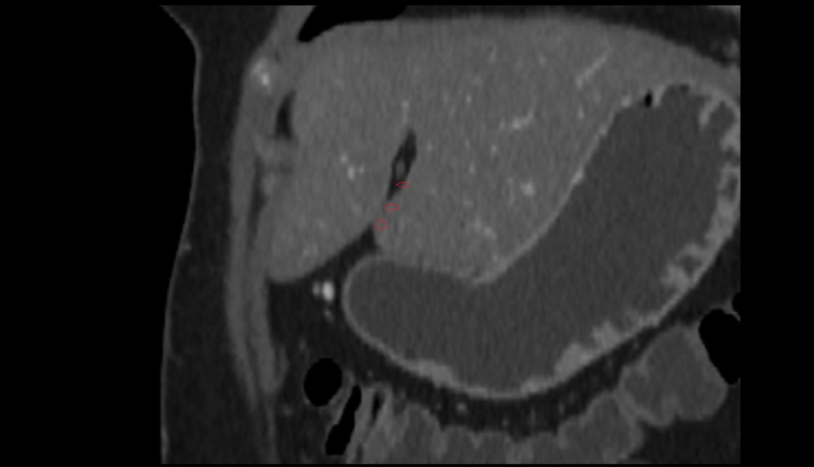 Fissure for ligamentum teres CT coronal image