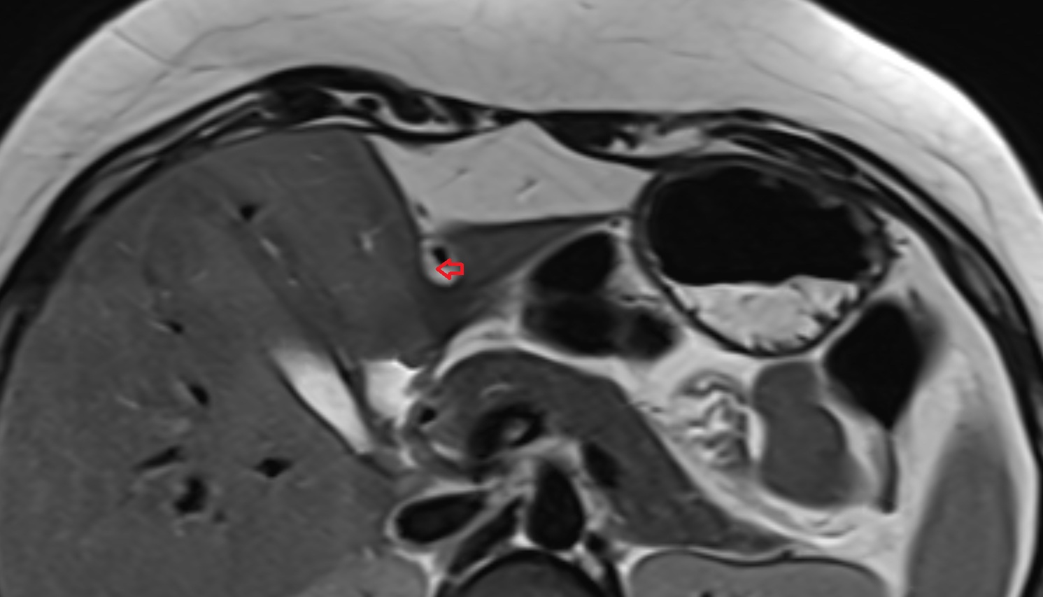 Fissure for ligamentum teres   MRI axial  anatomy  image-img-00000-00000