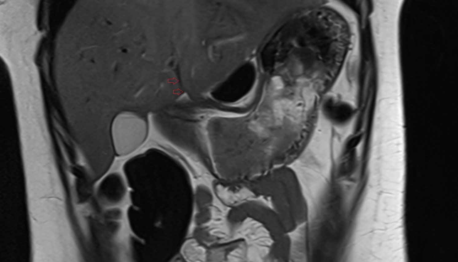 Fissure for ligamentum teres   MRI coronal  anatomy  image-img-00000-00000