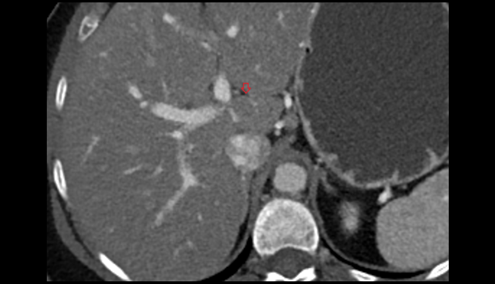 Fissure for ligamentum venosum CT axial image