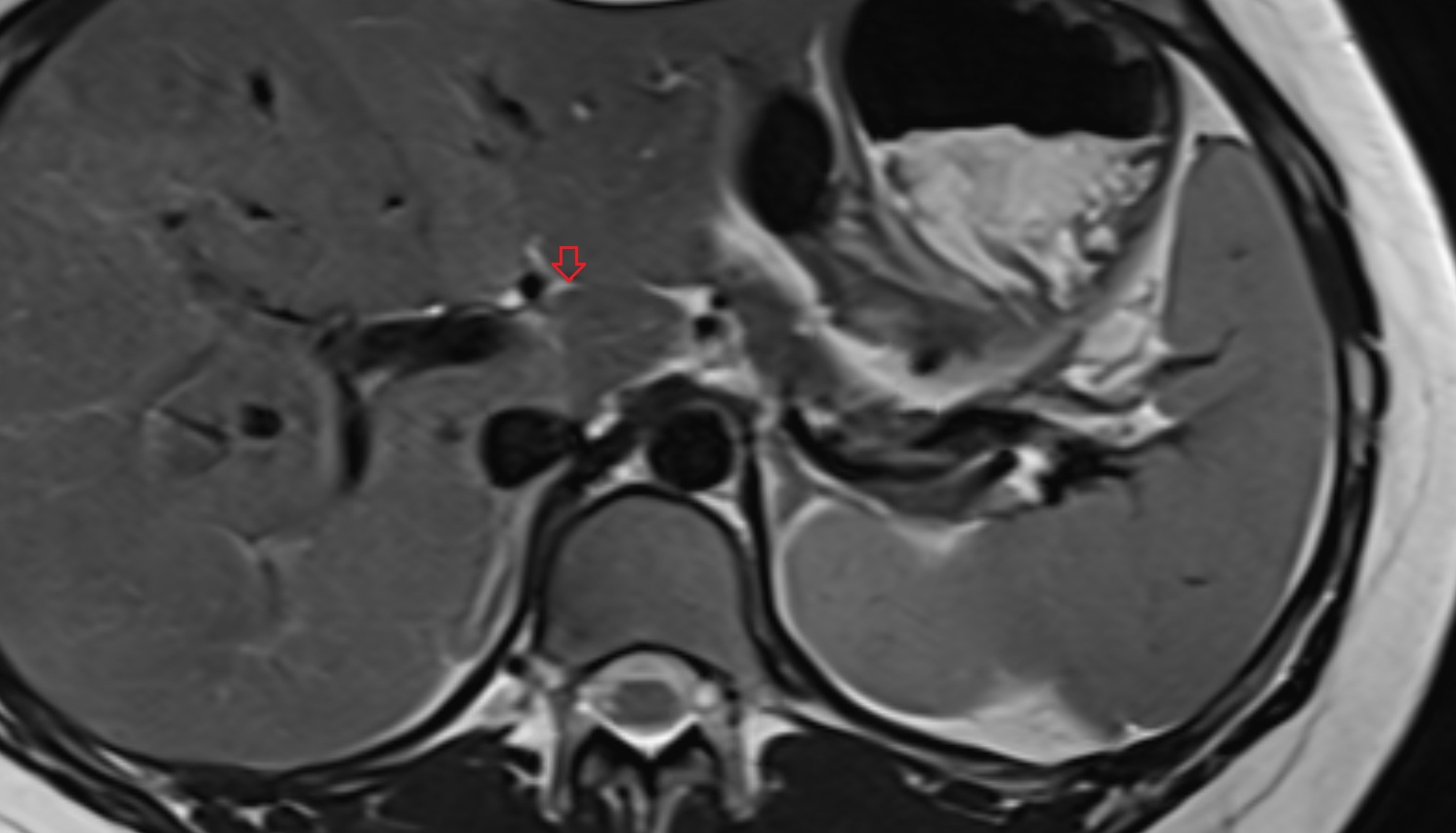 Fissure for ligamentum venosum  MRI axial  anatomy  image -img-00000-00000