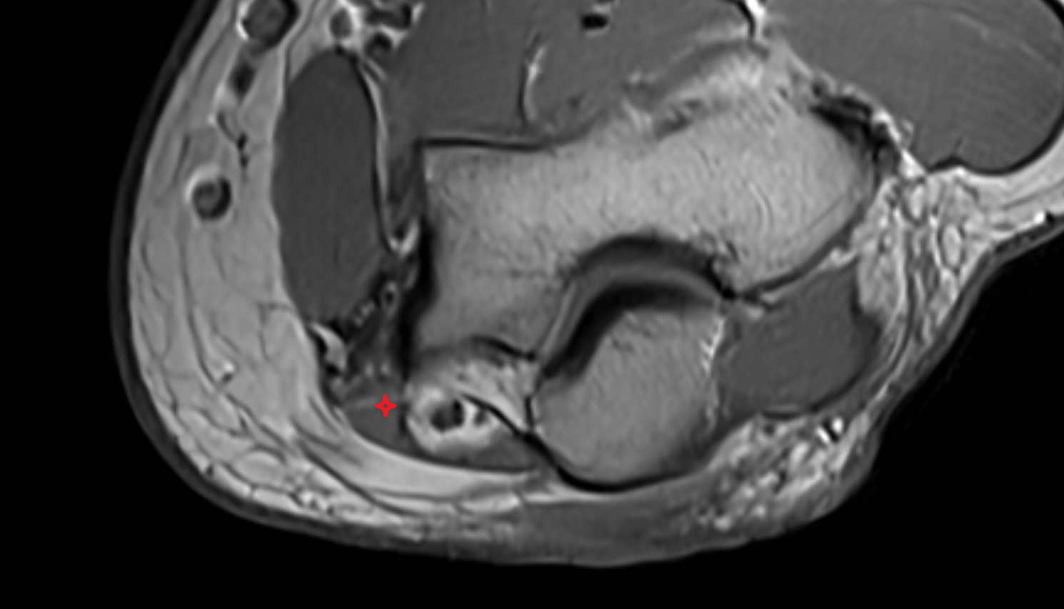 Flexor Carpi Ulnaris muscle (Humeral Head) axial cross sectional anatomy 3T MRI AI enhanced radiology image -img-00000-00000