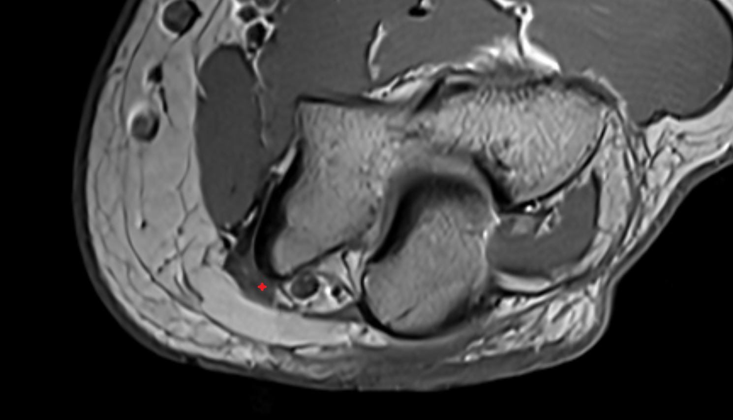 Flexor Carpi Ulnaris muscle (Humeral Head) axial cross sectional anatomy 3T MRI AI enhanced radiology image -img-00000-00000_00001