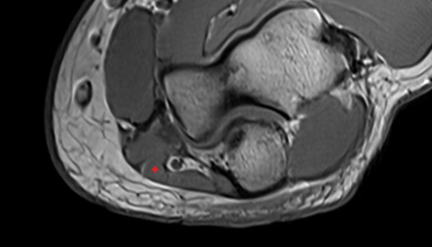 Flexor Carpi Ulnaris muscle (Humeral Head) axial cross sectional anatomy 3T MRI AI enhanced radiology image -img-00000-00000_00002