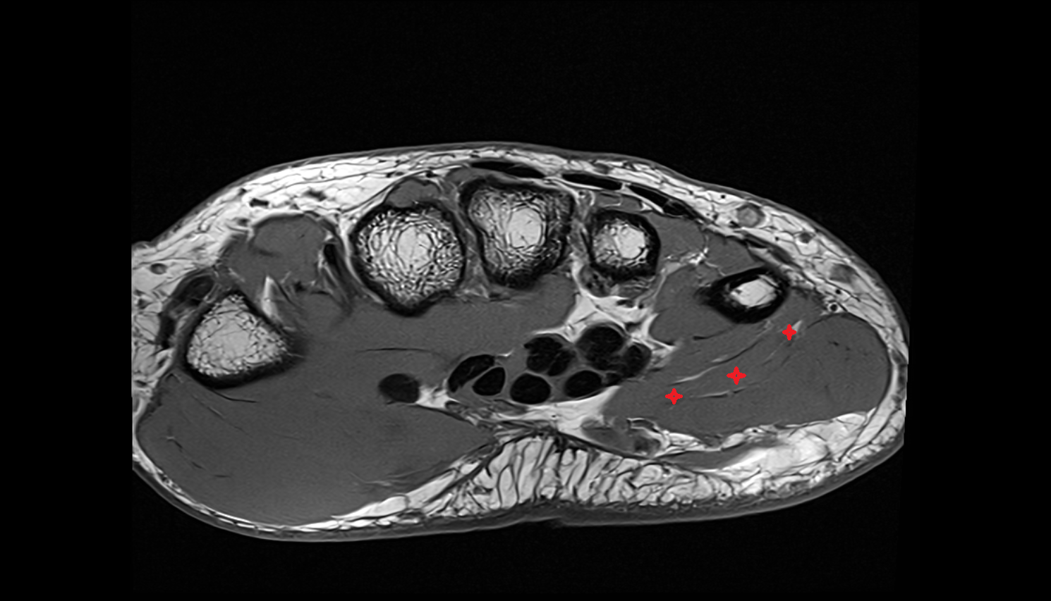 Flexor Digiti Minimi Brevis Muscle (Hand) axial cross sectional anatomy 3T MRI AI enhanced radiology image-img-00000-00000