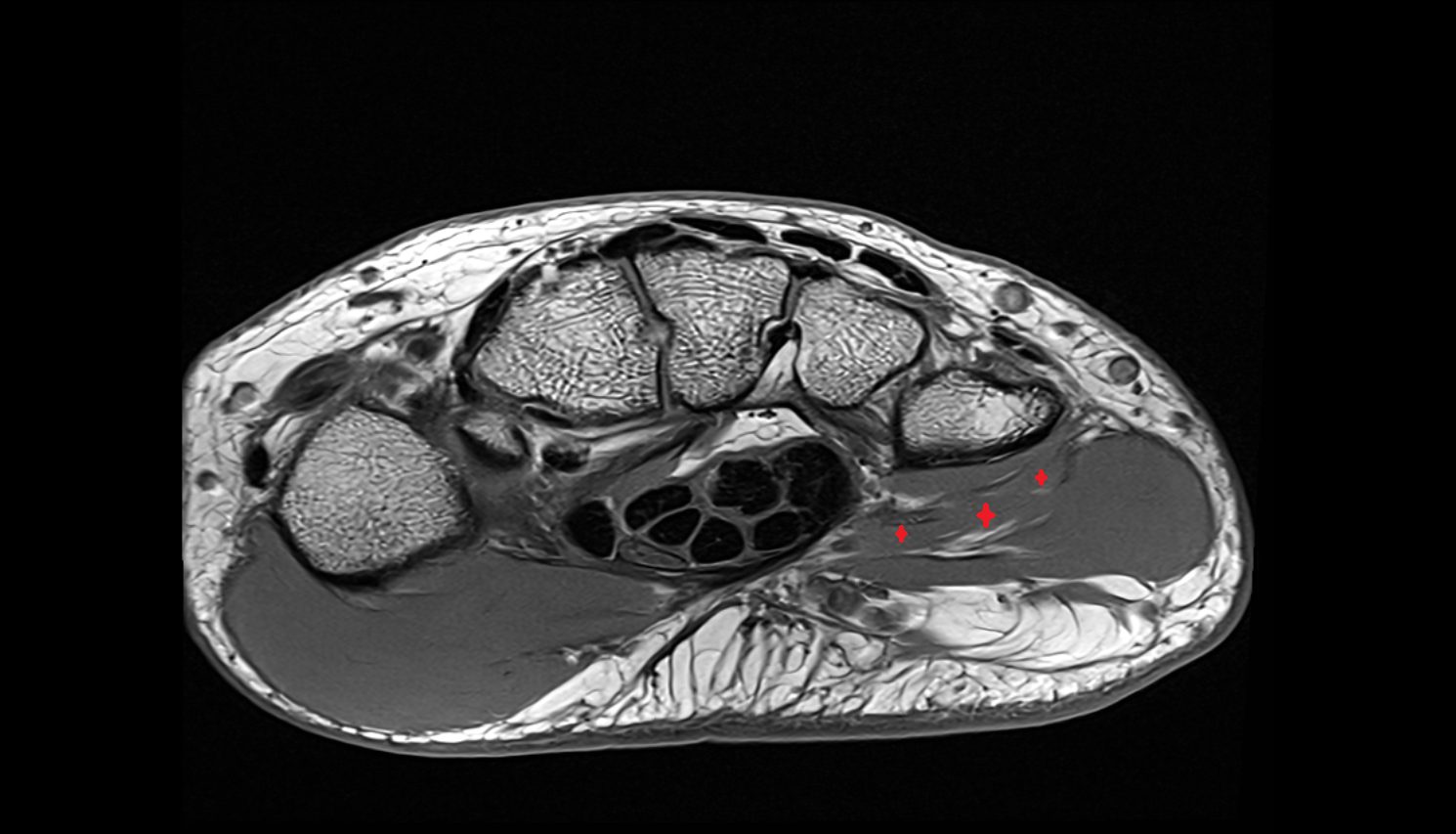 Flexor Digiti Minimi Brevis Muscle (Hand) axial cross sectional anatomy 3T MRI AI enhanced radiology image-img-00000-00000_00001