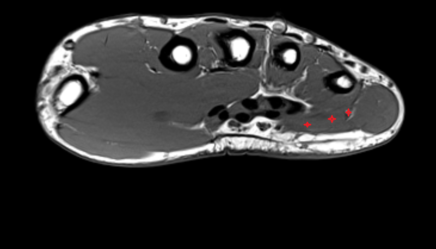 Flexor Digiti Minimi Brevis Muscle (Hand) axial cross sectional anatomy 3T MRI AI enhanced radiology image-img-00000-00000_00002
