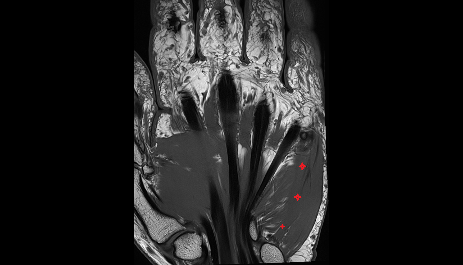 Flexor Digiti Minimi Brevis Muscle (Hand) coronal cross sectional anatomy 3T MRI AI enhanced radiology image-img-00000-00000_00002