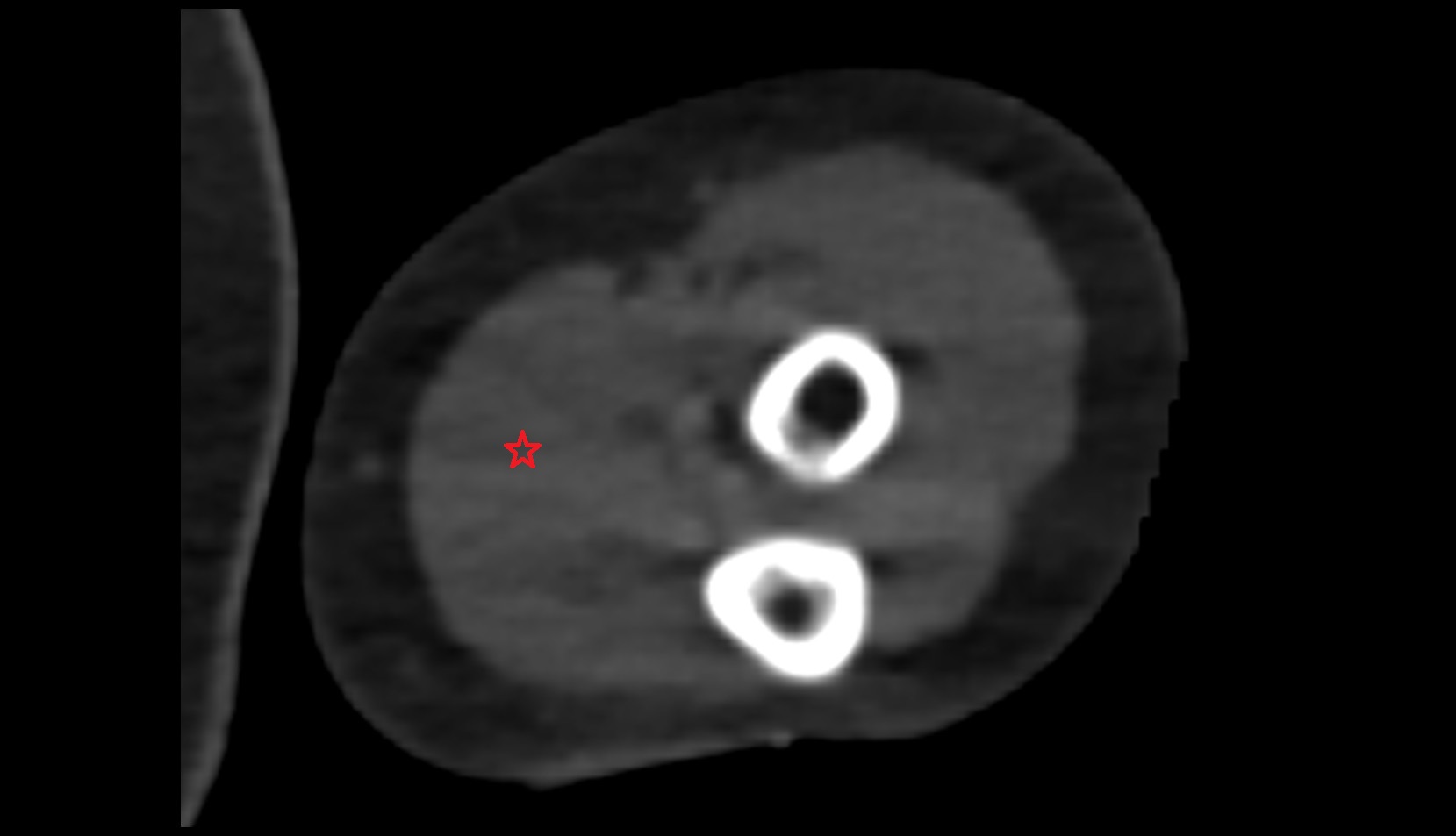 Flexor Digitorum Superficialis Muscle ct axial
