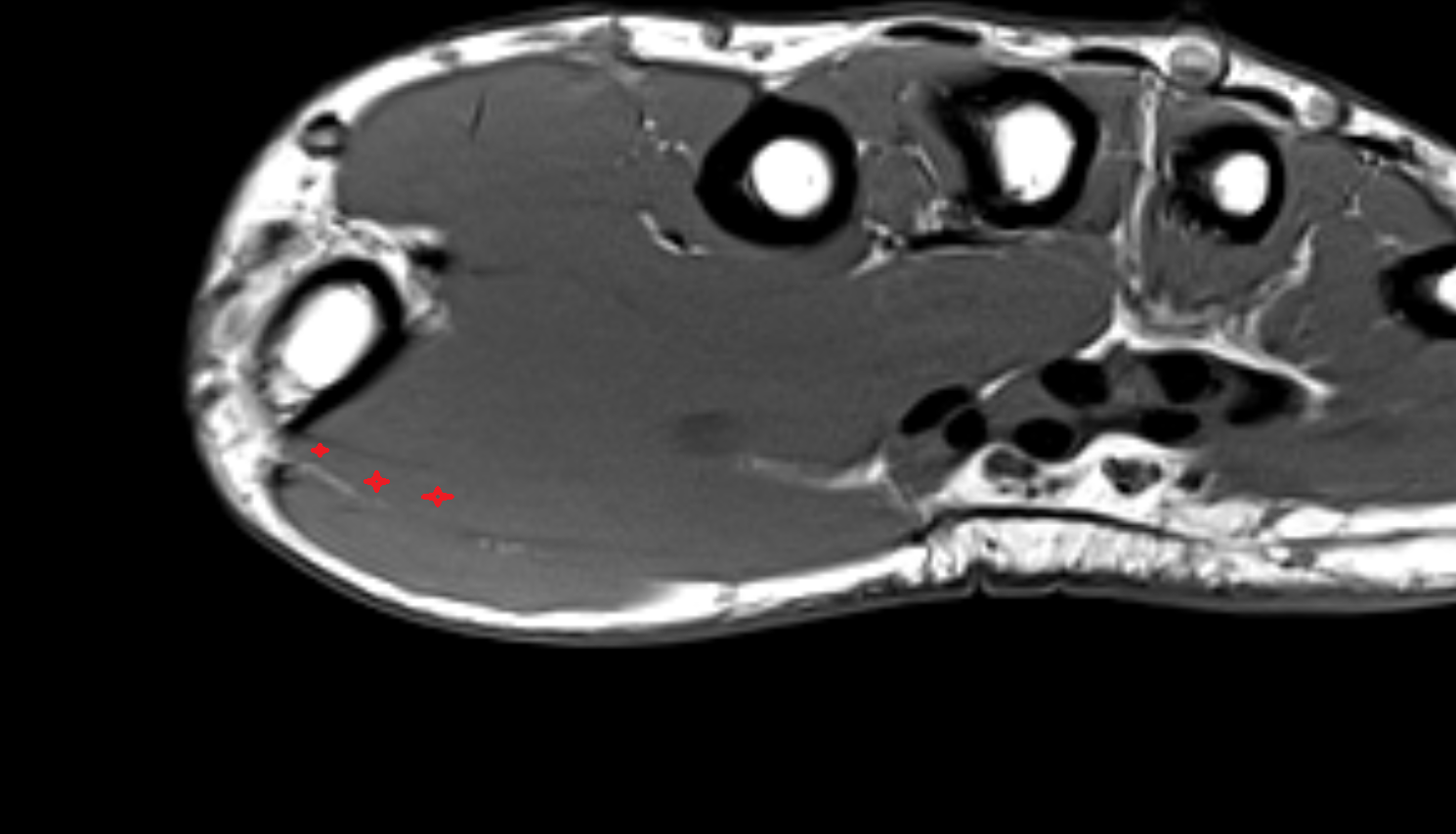 Flexor Pollicis Brevis (Superficial Head)  muscle axial cross sectional anatomy 3T MRI AI enhanced radiology image-img-00000-00000