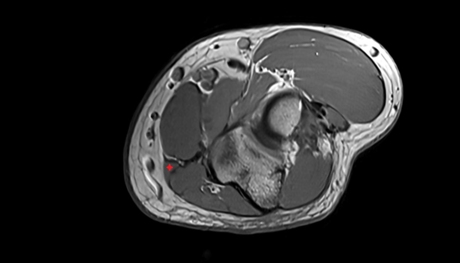 Flexor carpi radialis muscle axial cross sectional anatomy 3T MRI AI enhanced radiology image -img-00000-00000