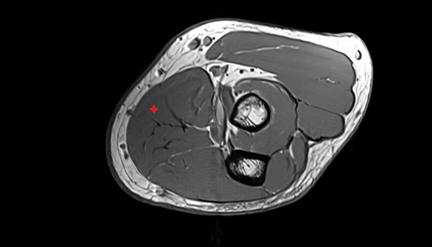 Flexor carpi radialis muscle axial cross sectional anatomy 3T MRI AI enhanced radiology image -img-00000-00000_00001