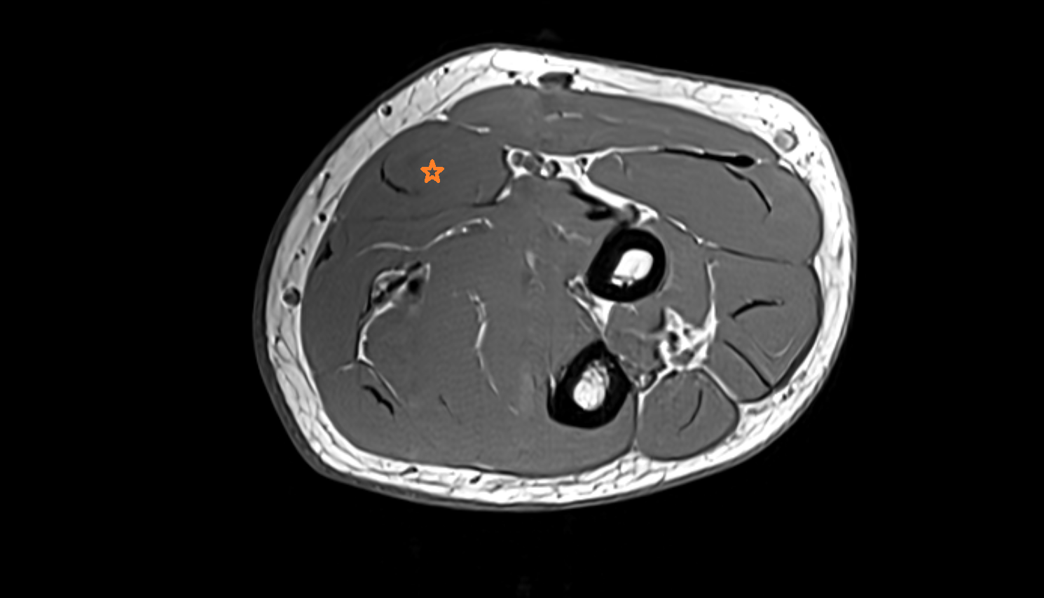 Flexor carpi radialis muscle axial cross sectional anatomy 3T MRI AI enhanced radiology image -img-00000-00000_00002