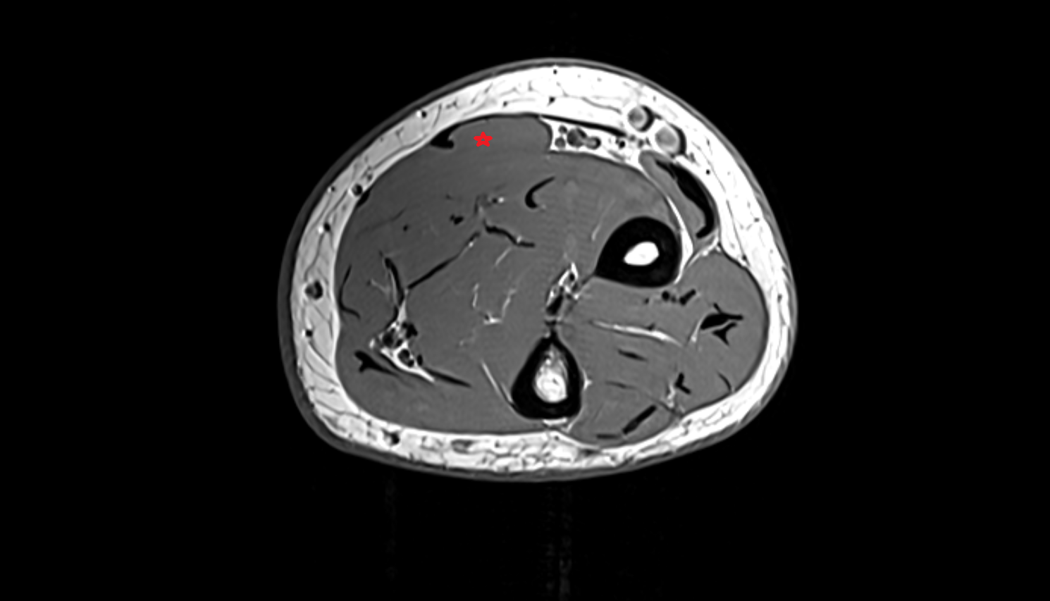 Flexor carpi radialis muscle axial cross sectional anatomy 3T MRI AI enhanced radiology image -img-00000-00000_00003