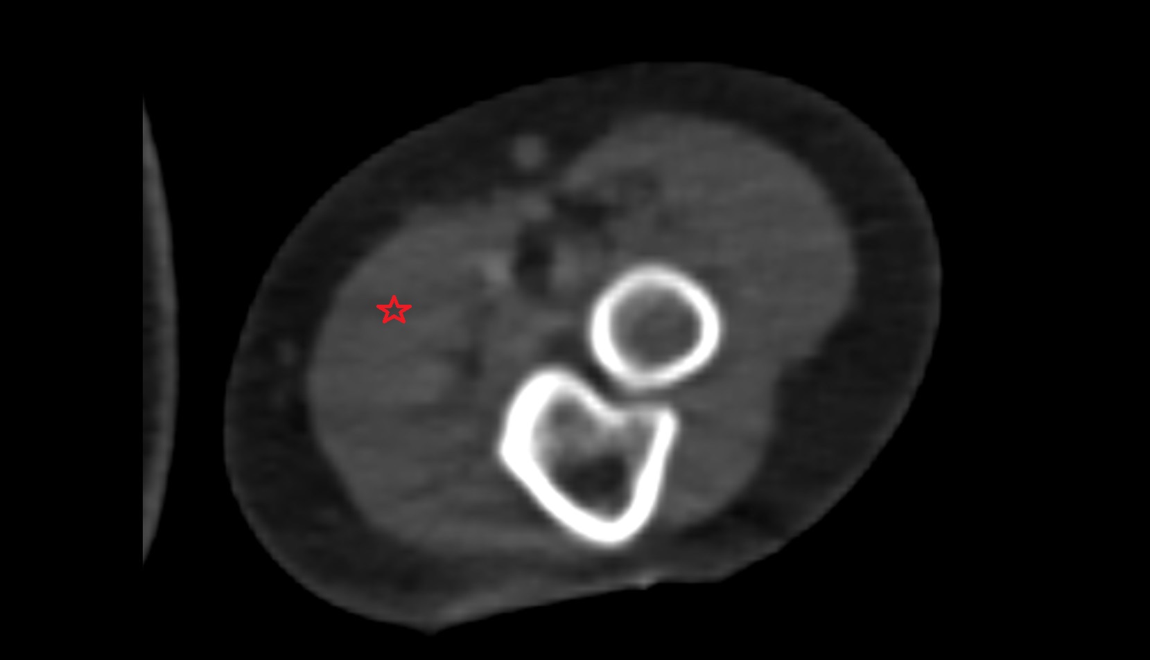 Flexor carpi radialis muscle ct axial image