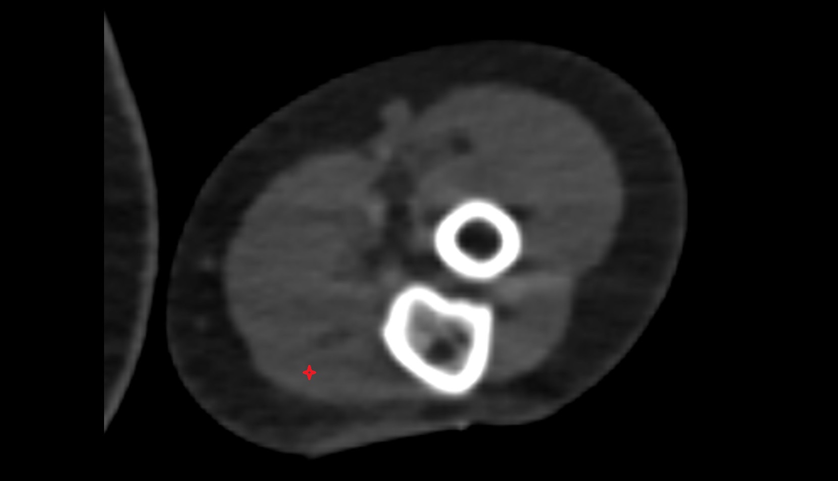 Flexor carpi ulnaris ct axial image