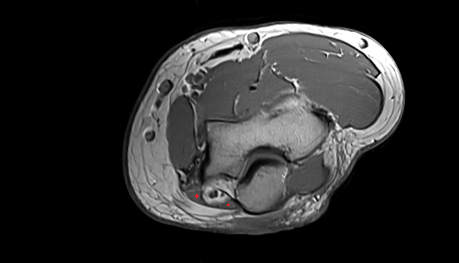 Flexor carpi ulnaris muscle axial cross sectional anatomy 3T MRI AI enhanced radiology image -img-00000-00000