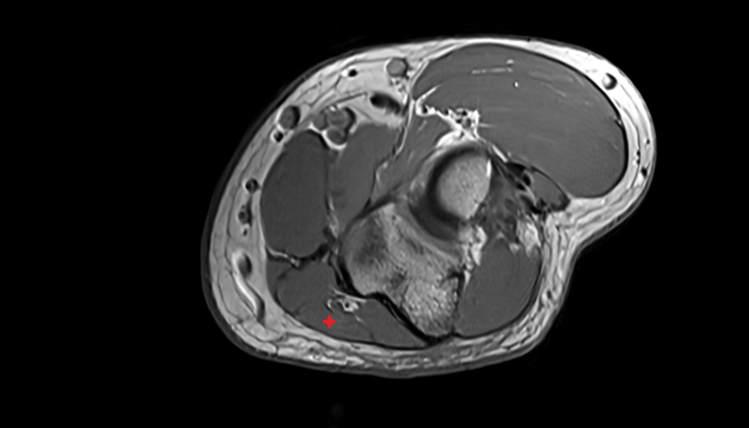 Flexor carpi ulnaris muscle axial cross sectional anatomy 3T MRI AI enhanced radiology image -img-00000-00000_00001