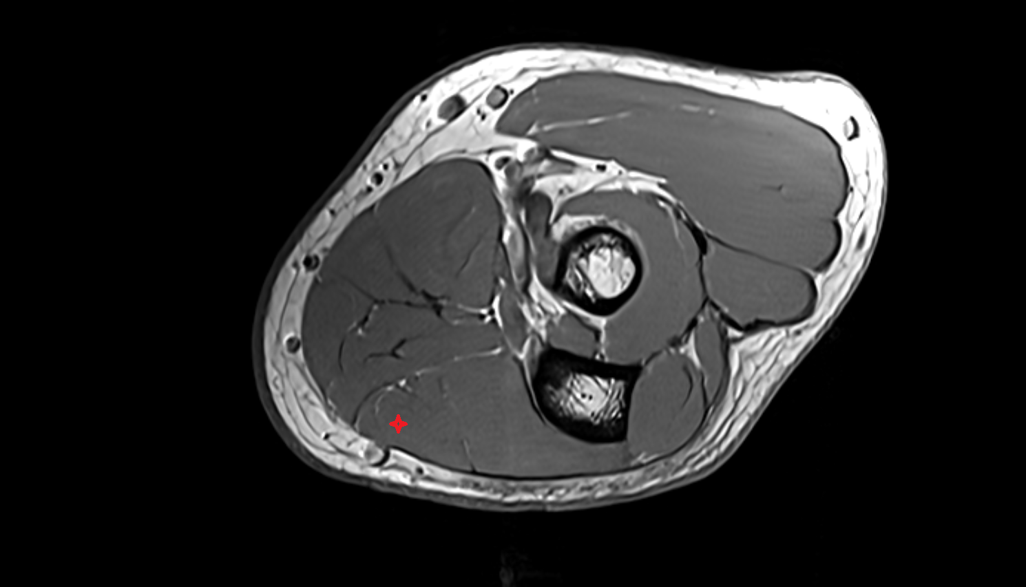 Flexor carpi ulnaris muscle axial cross sectional anatomy 3T MRI AI enhanced radiology image -img-00000-00000_00002