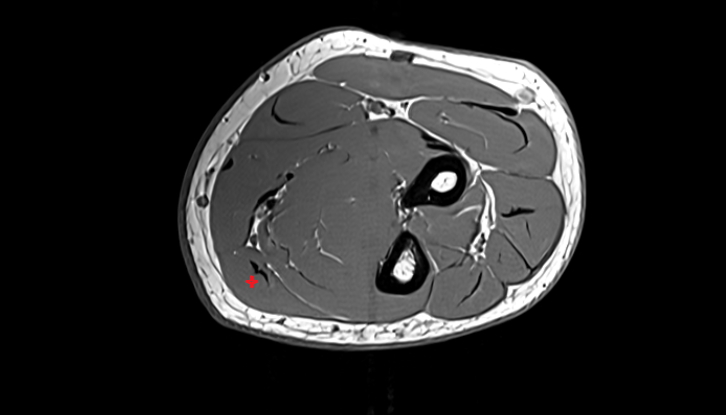 Flexor carpi ulnaris muscle axial cross sectional anatomy 3T MRI AI enhanced radiology image -img-00000-00000_00003