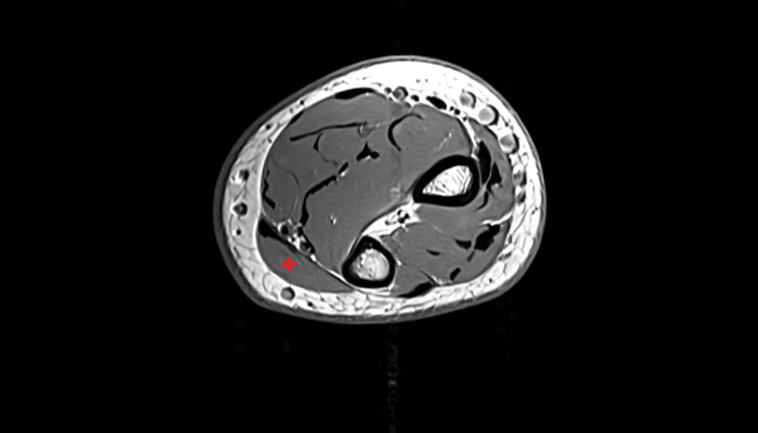 Flexor carpi ulnaris muscle axial cross sectional anatomy 3T MRI AI enhanced radiology image -img-00000-00000_00004