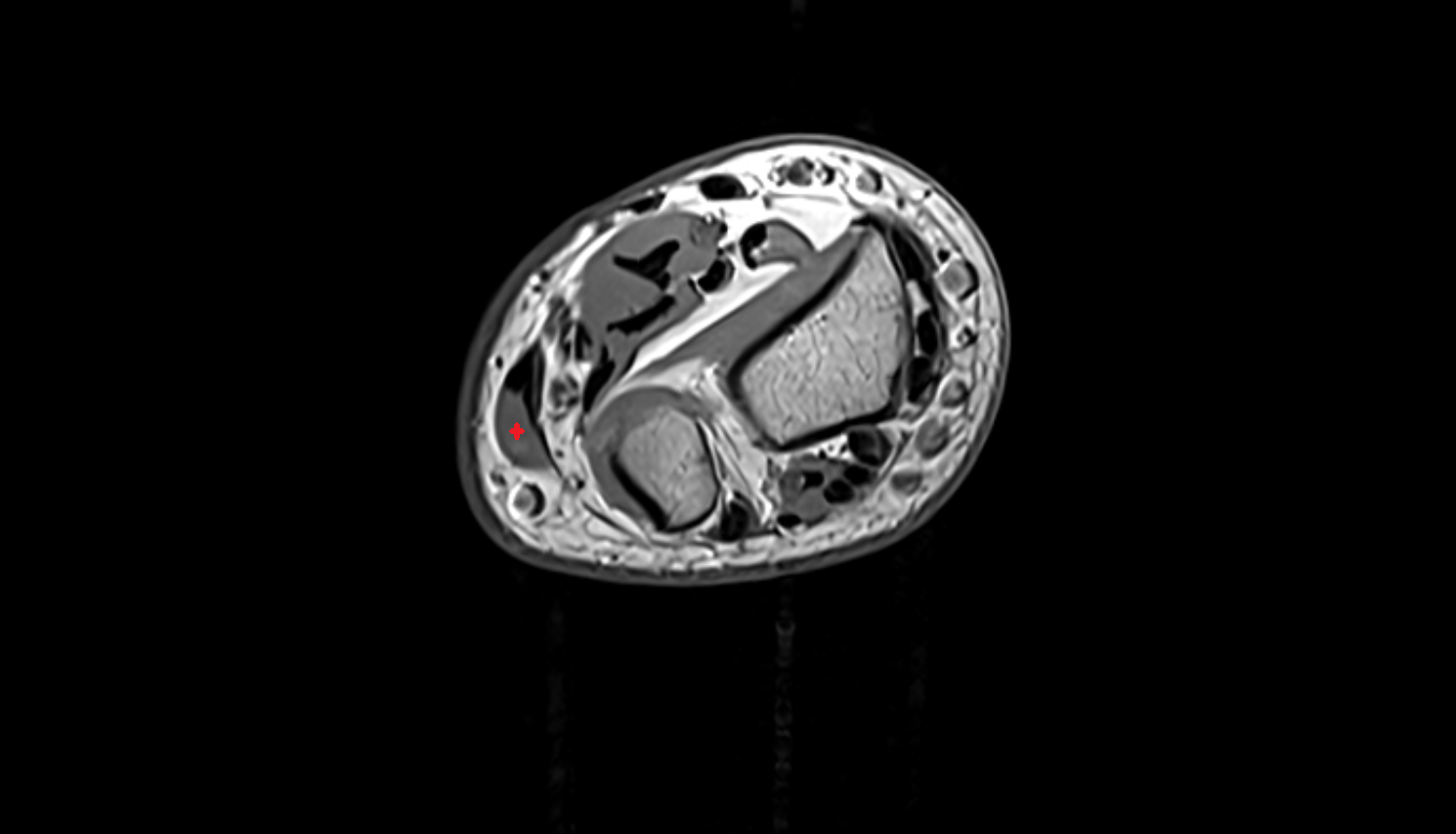 Flexor carpi ulnaris muscle axial cross sectional anatomy 3T MRI AI enhanced radiology image -img-00000-00000_00005