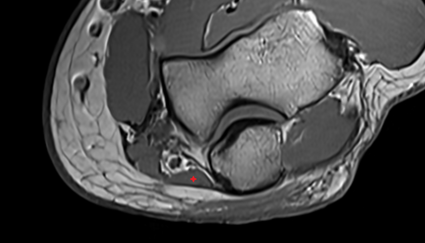 Flexor carpi ulnaris muscle (ulnar head) axial cross sectional anatomy 3T MRI AI enhanced radiology image -img-00000-00000_00001
