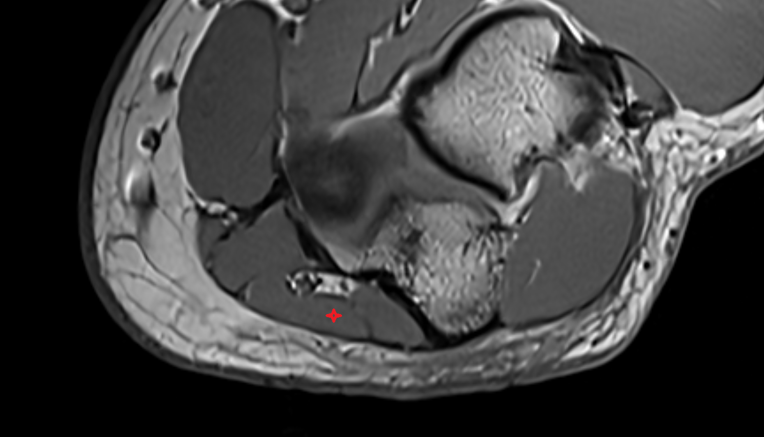 Flexor carpi ulnaris muscle (ulnar head) axial cross sectional anatomy 3T MRI AI enhanced radiology image -img-00000-00000_00002