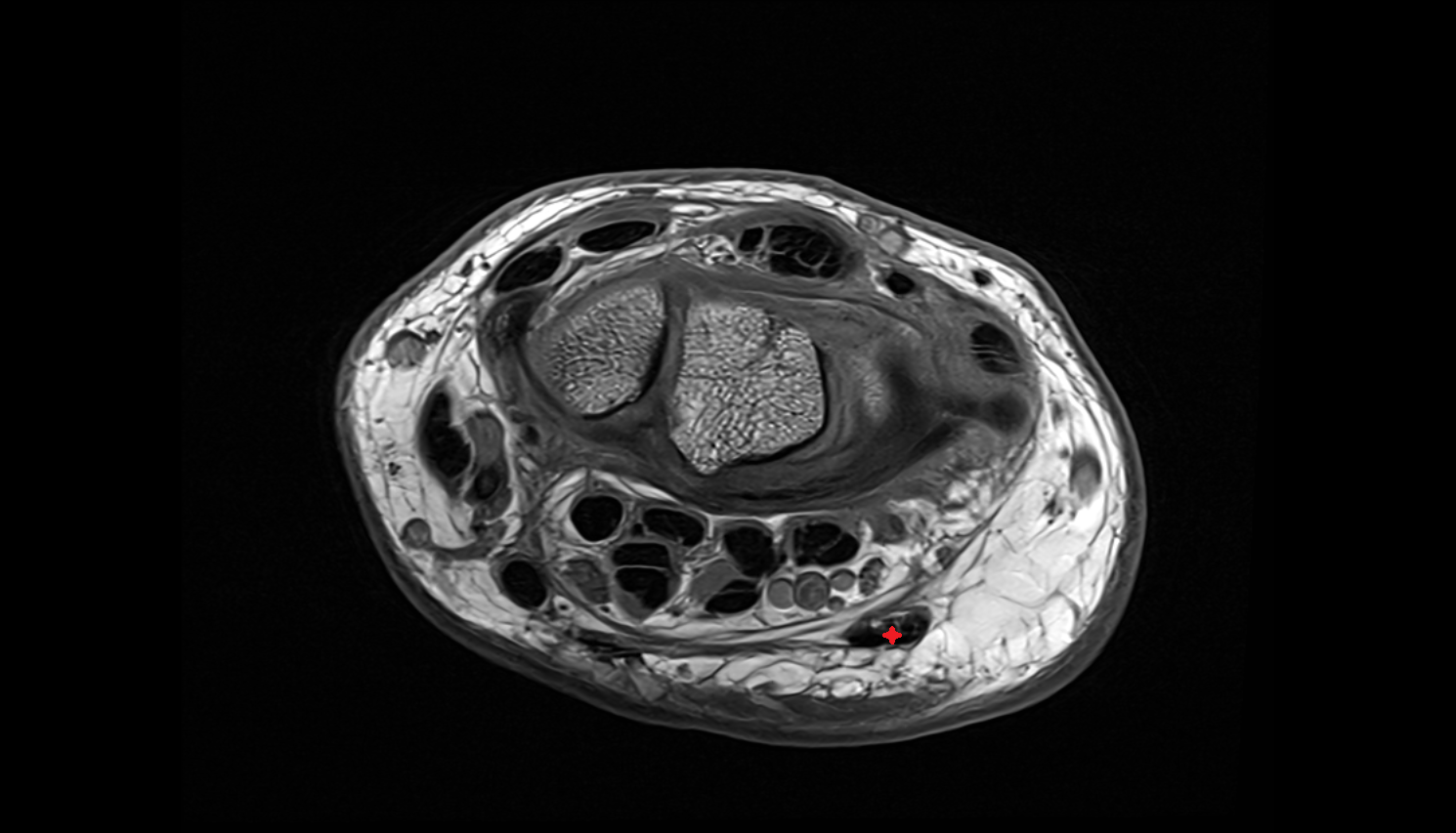 Flexor carpi ulnaris tendon axial cross sectional anatomy 3T MRI AI enhanced radiology image-img-00000-00000_00001