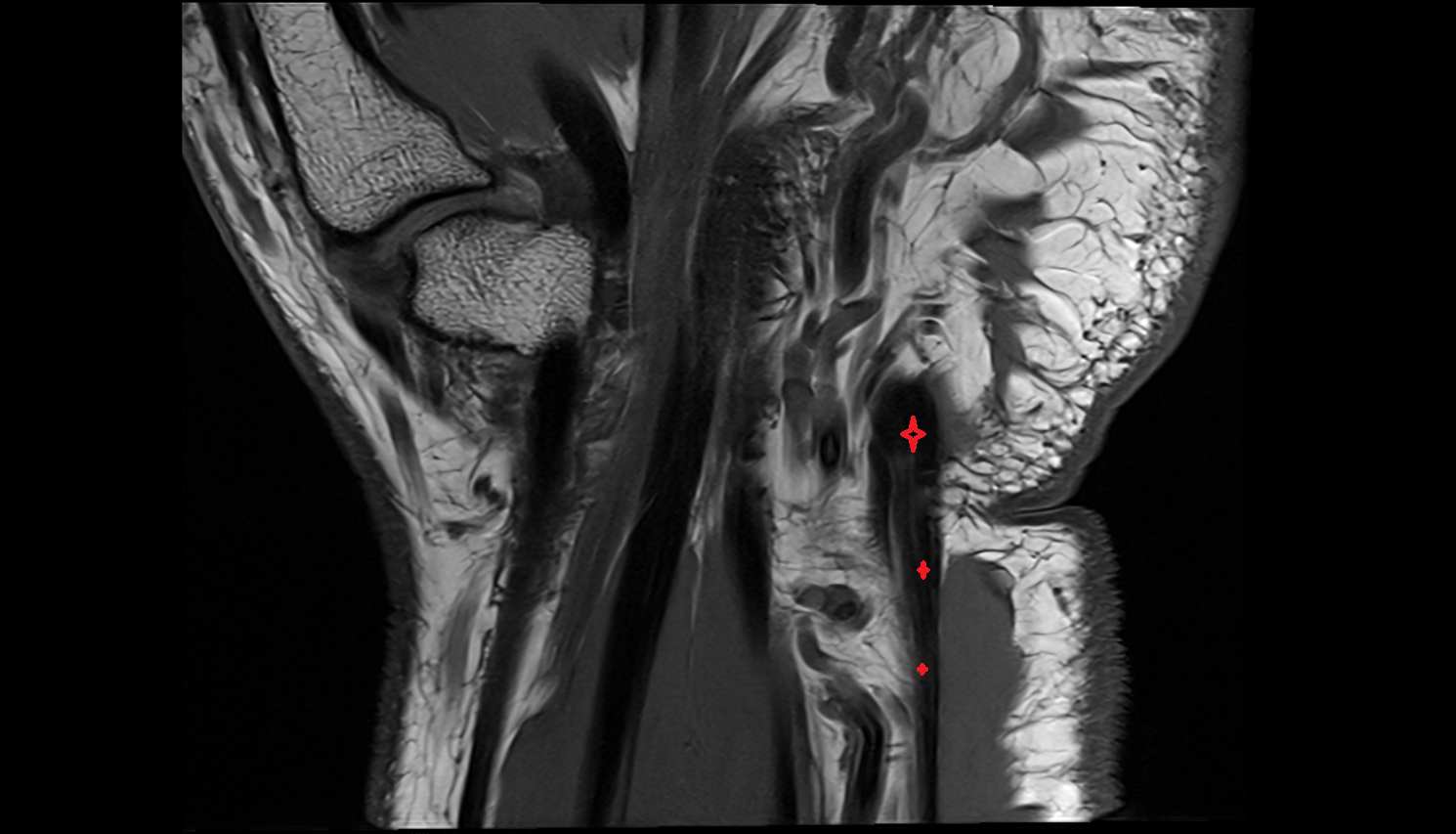 Flexor carpi ulnaris tendon coronal cross sectional anatomy 3T MRI AI enhanced radiology image-img-00000-00000