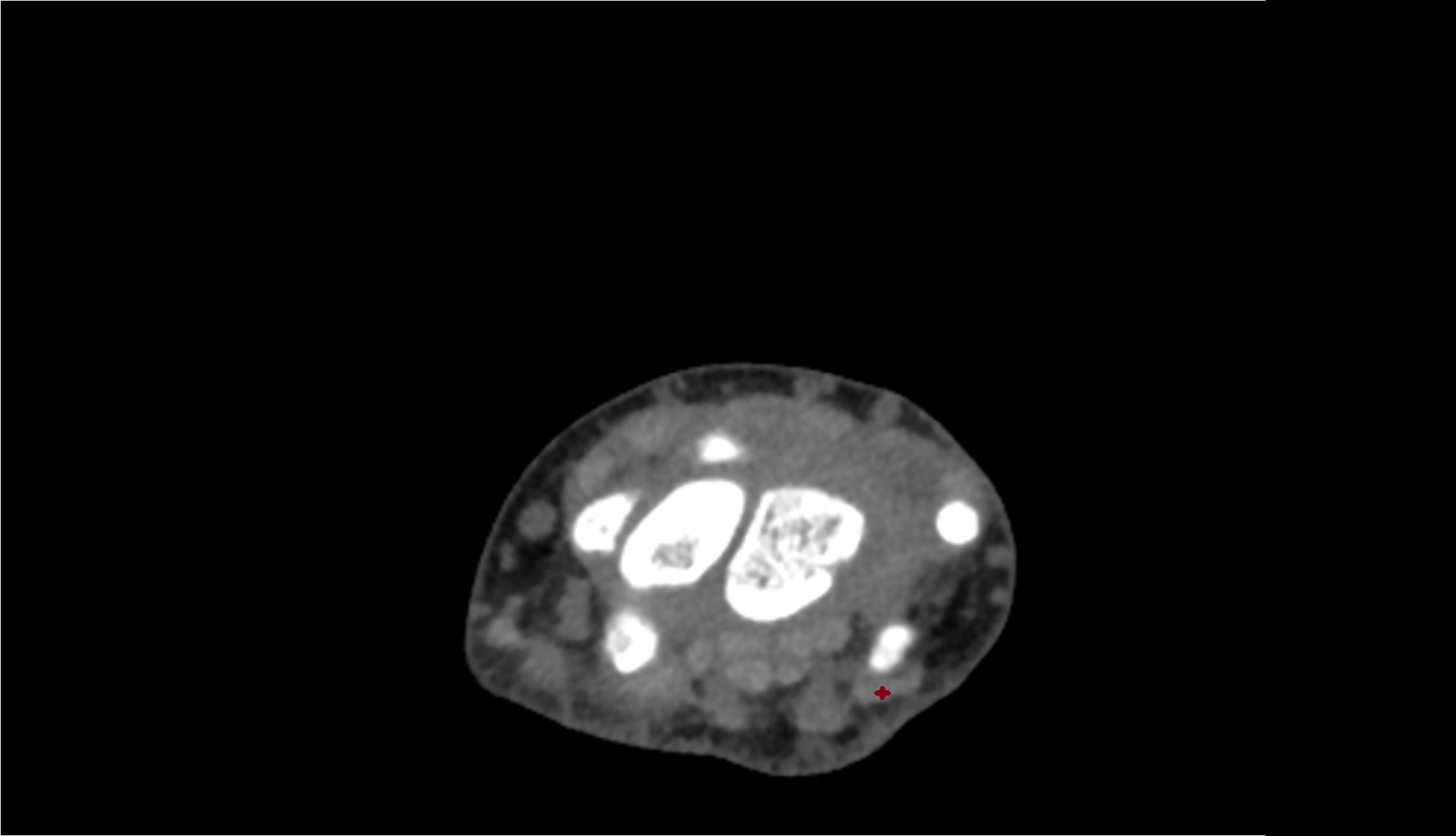 Flexor carpi ulnaris tendon ct axial 1