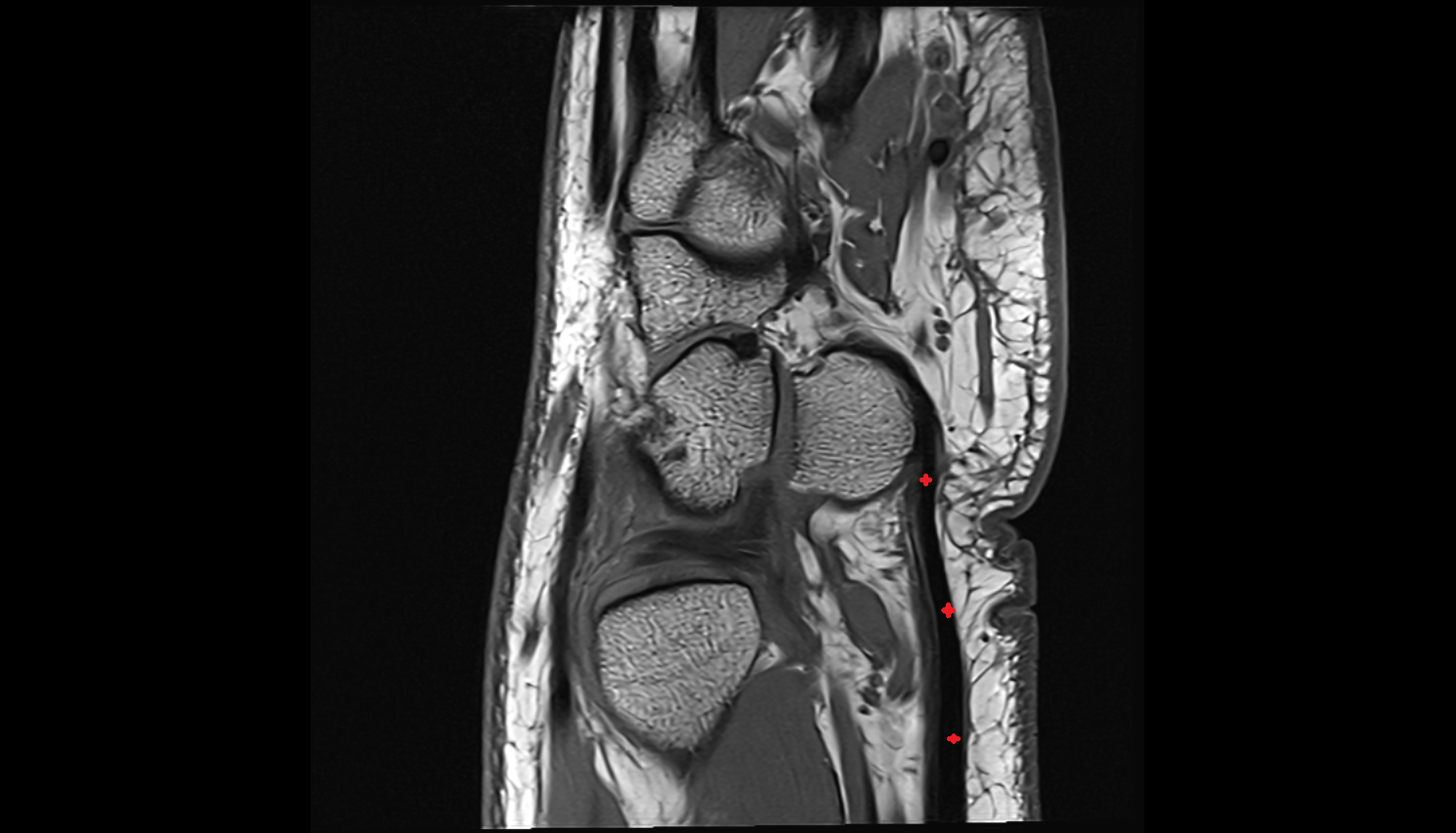Flexor carpi ulnaris tendon sag cross sectional anatomy 3T MRI AI enhanced radiology image-img-00000-00000