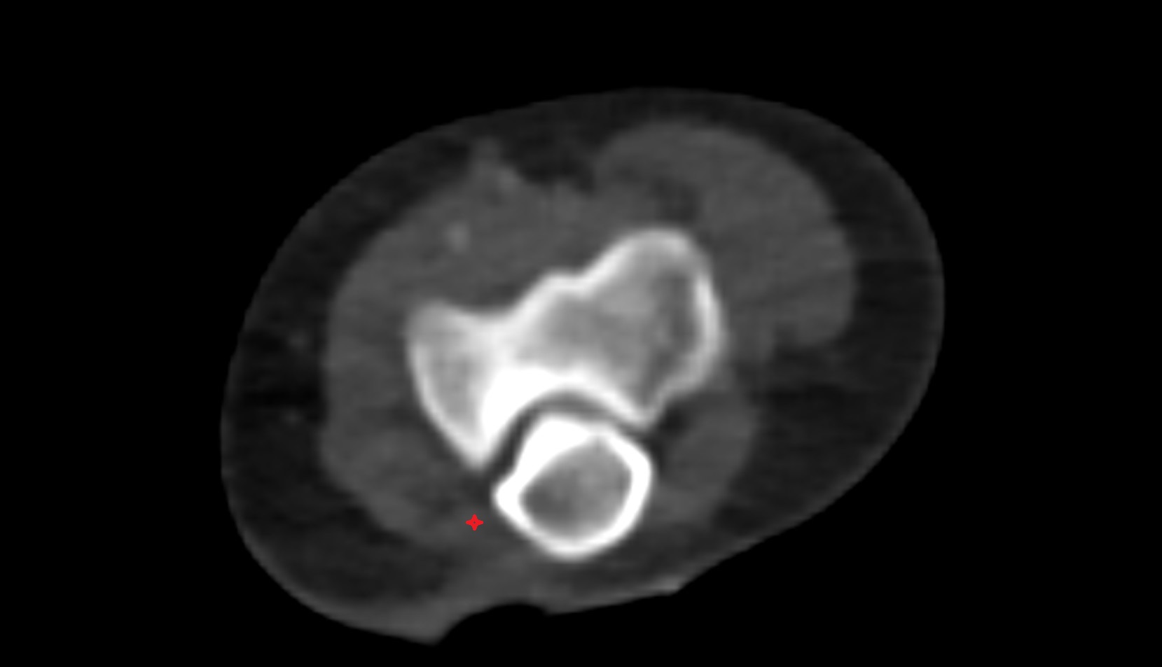 Flexor carpi ulnaris (ulnar head) ct axial image