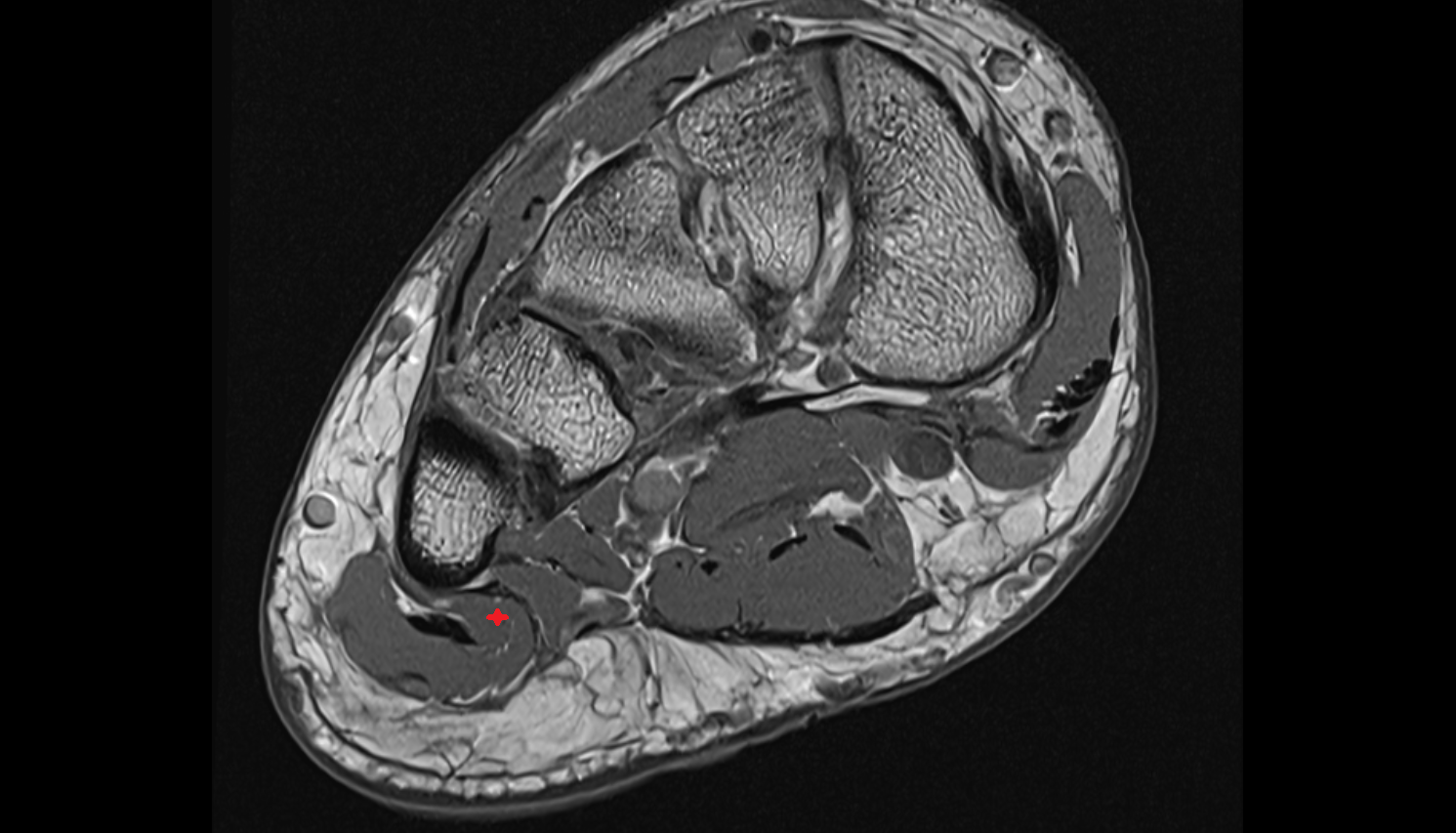 Flexor digiti minimi brevis muscle axial cross sectional anatomy 3T MRI AI enhanced radiology image-img-00000-00000
