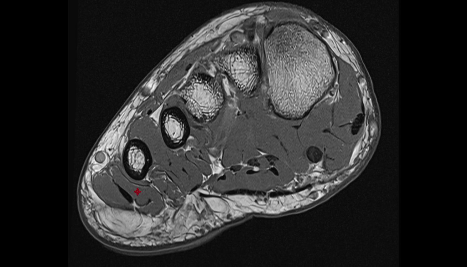 Flexor digiti minimi brevis muscle axial cross sectional anatomy 3T MRI AI enhanced radiology image-img-00000-00000_00001