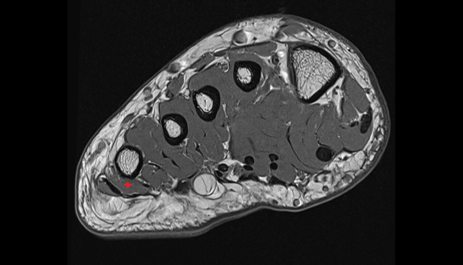Flexor digiti minimi brevis muscle axial cross sectional anatomy 3T MRI AI enhanced radiology image-img-00000-00000_00002