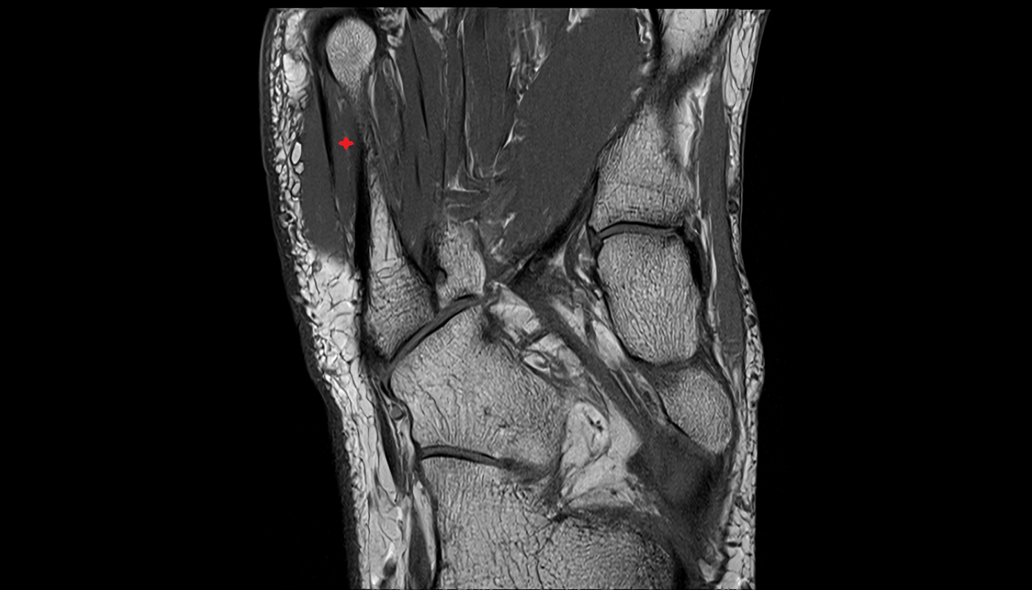 Flexor digiti minimi brevis muscle coronal cross sectional anatomy 3T MRI AI enhanced radiology image-img-00000-00000