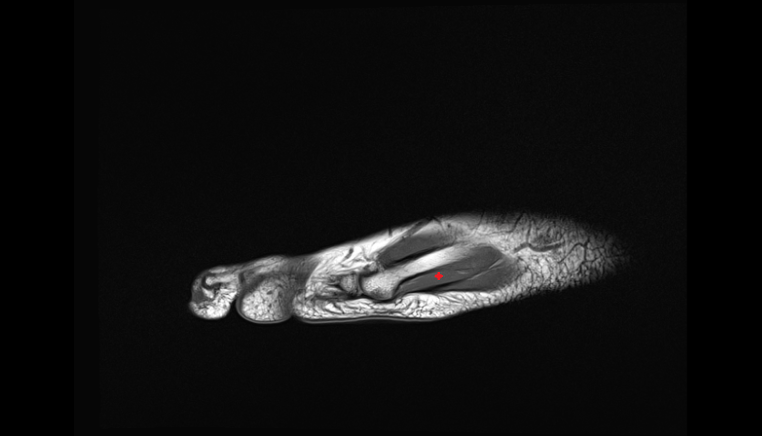 Flexor digiti minimi brevis muscle coronal cross sectional anatomy 3T MRI AI enhanced radiology image-img-00000-00000_00001