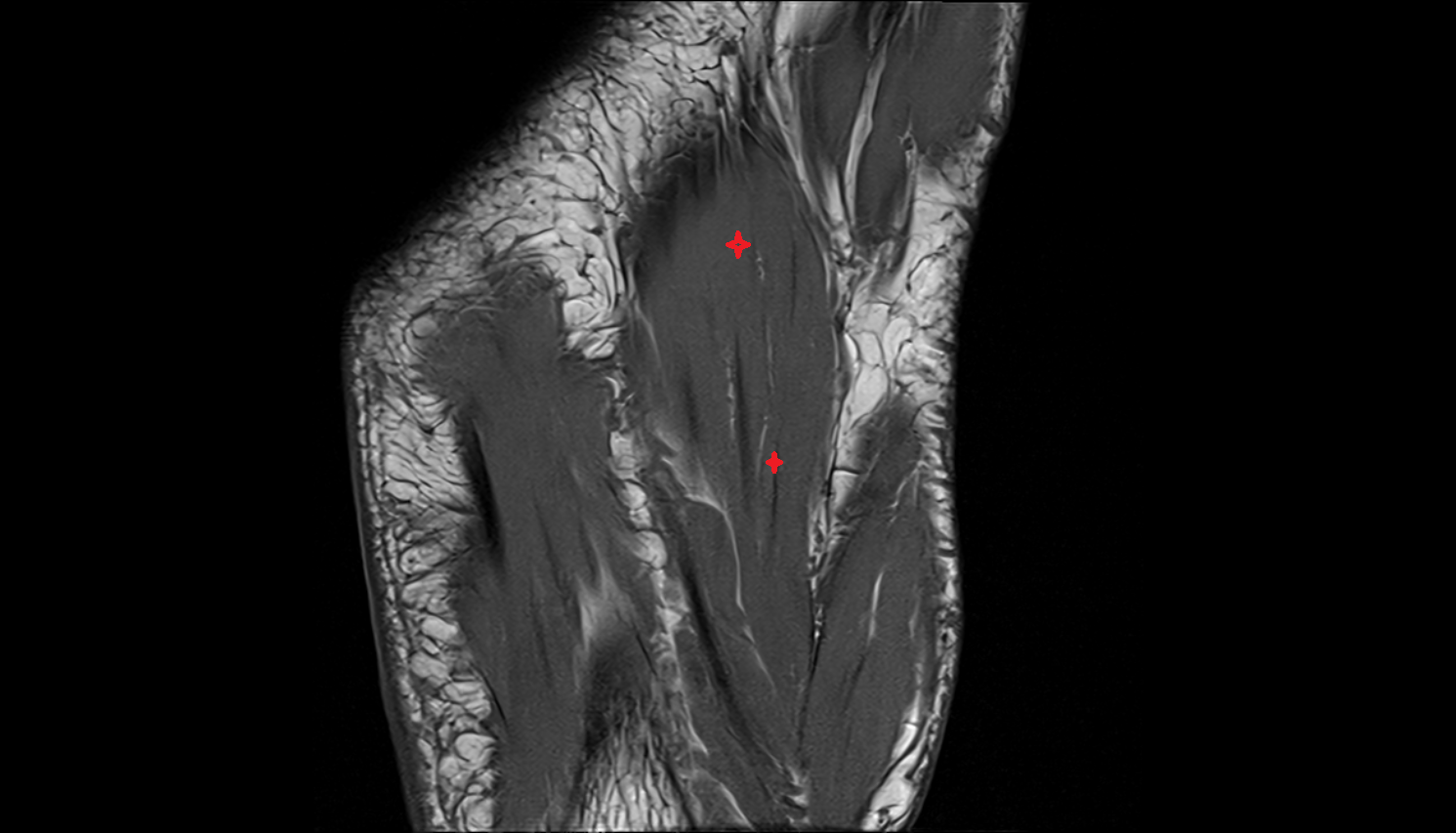 Flexor digitorum brevis muscle CORONAL cross sectional anatomy 3T MRI AI enhanced radiology image-img-00000-00000