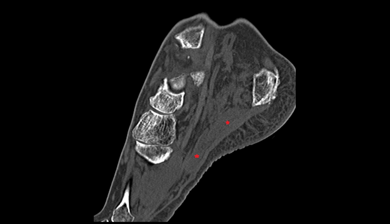 Flexor digitorum brevis muscle CT sagittal image