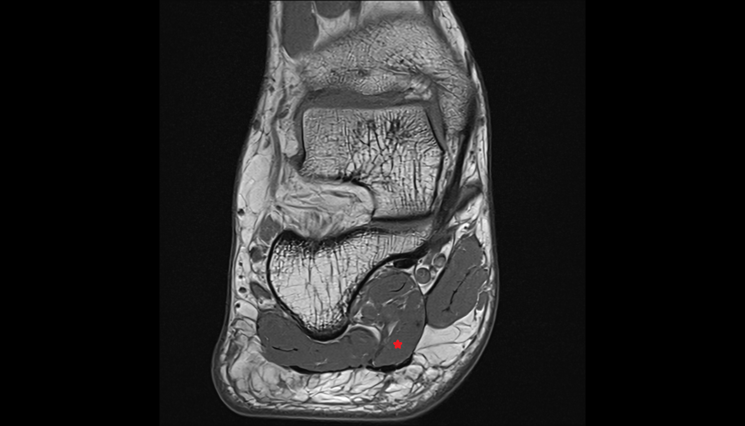 Flexor digitorum brevis muscle axial cross sectional anatomy 3T MRI AI enhanced radiology image-img-00000-00000