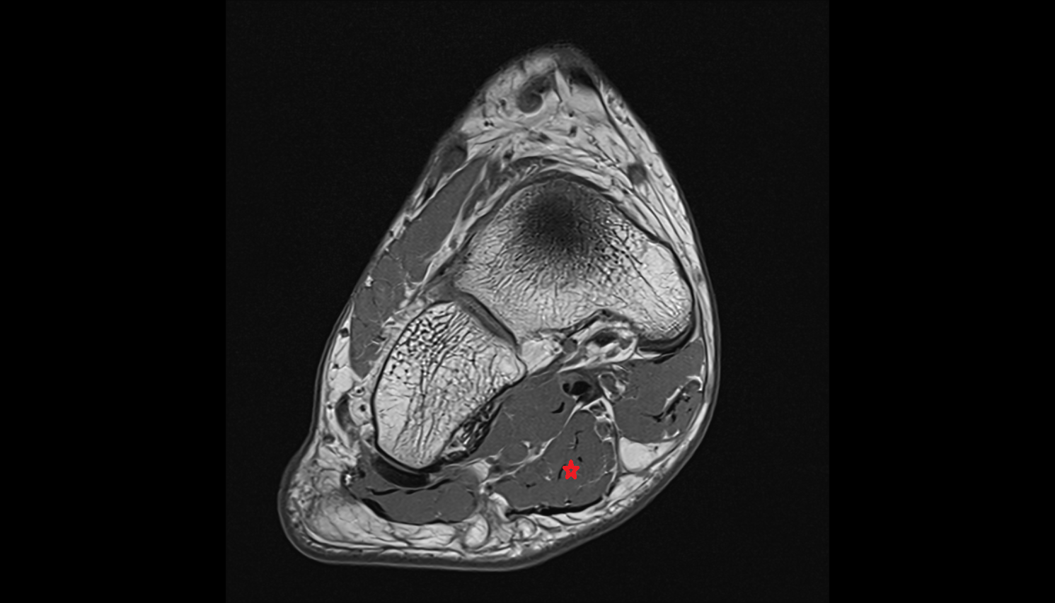 Flexor digitorum brevis muscle axial cross sectional anatomy 3T MRI AI enhanced radiology image-img-00000-00000_00001