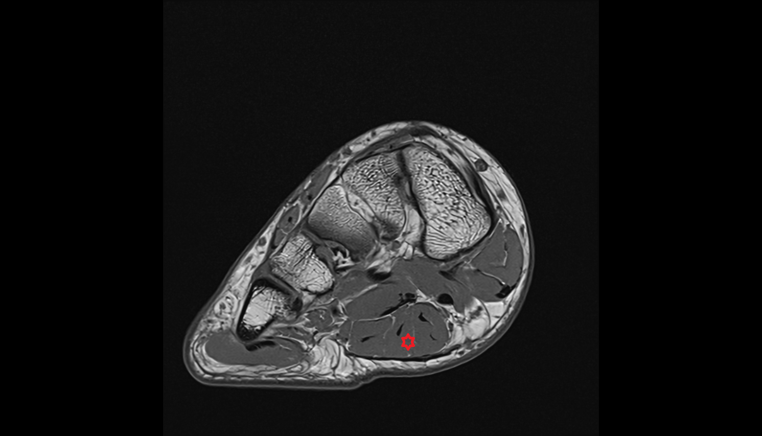 Flexor digitorum brevis muscle axial cross sectional anatomy 3T MRI AI enhanced radiology image-img-00000-00000_00002