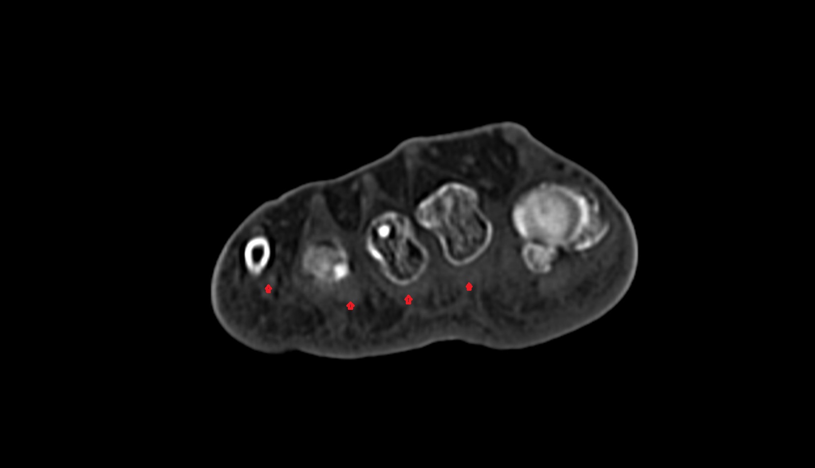 Flexor digitorum brevis tendons ct axial