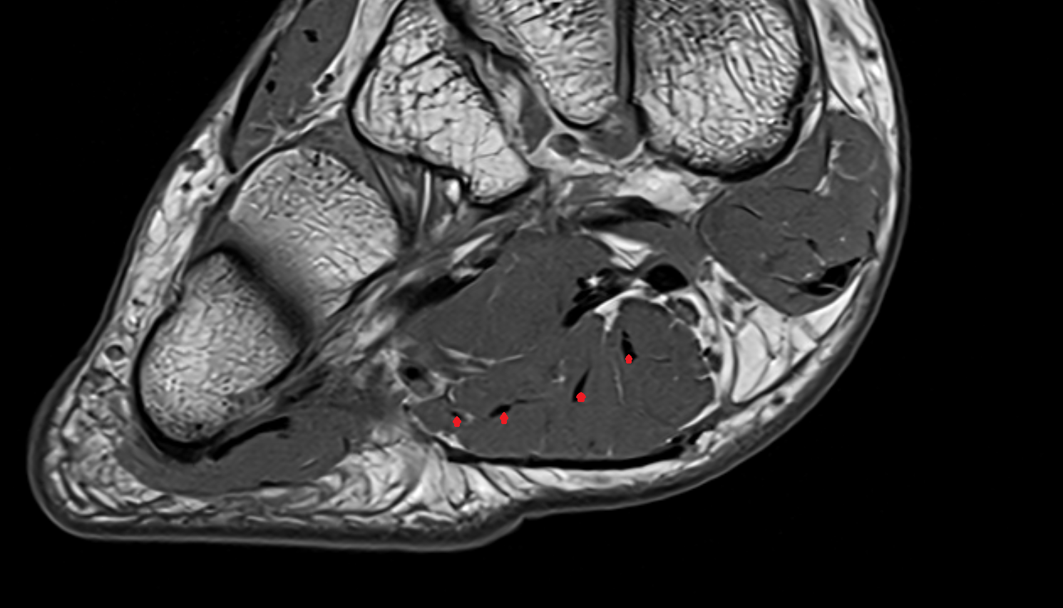 Flexor digitorum brevis tendons  of the Foot  axial cross sectional anatomy 3T MRI AI enhanced radiology image-img-00000-00000