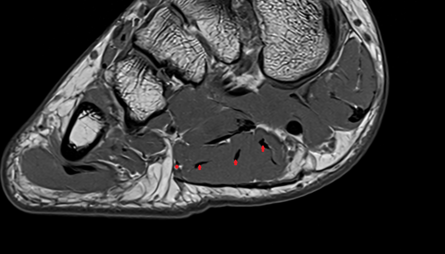 Flexor digitorum brevis tendons  of the Foot  axial cross sectional anatomy 3T MRI AI enhanced radiology image-img-00000-00000_00001