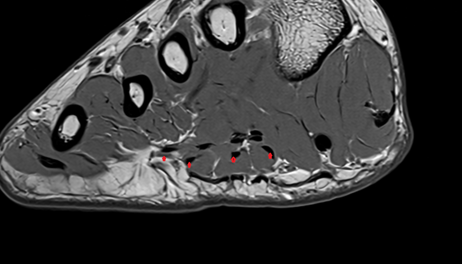 Flexor digitorum brevis tendons  of the Foot  axial cross sectional anatomy 3T MRI AI enhanced radiology image-img-00000-00000_00002