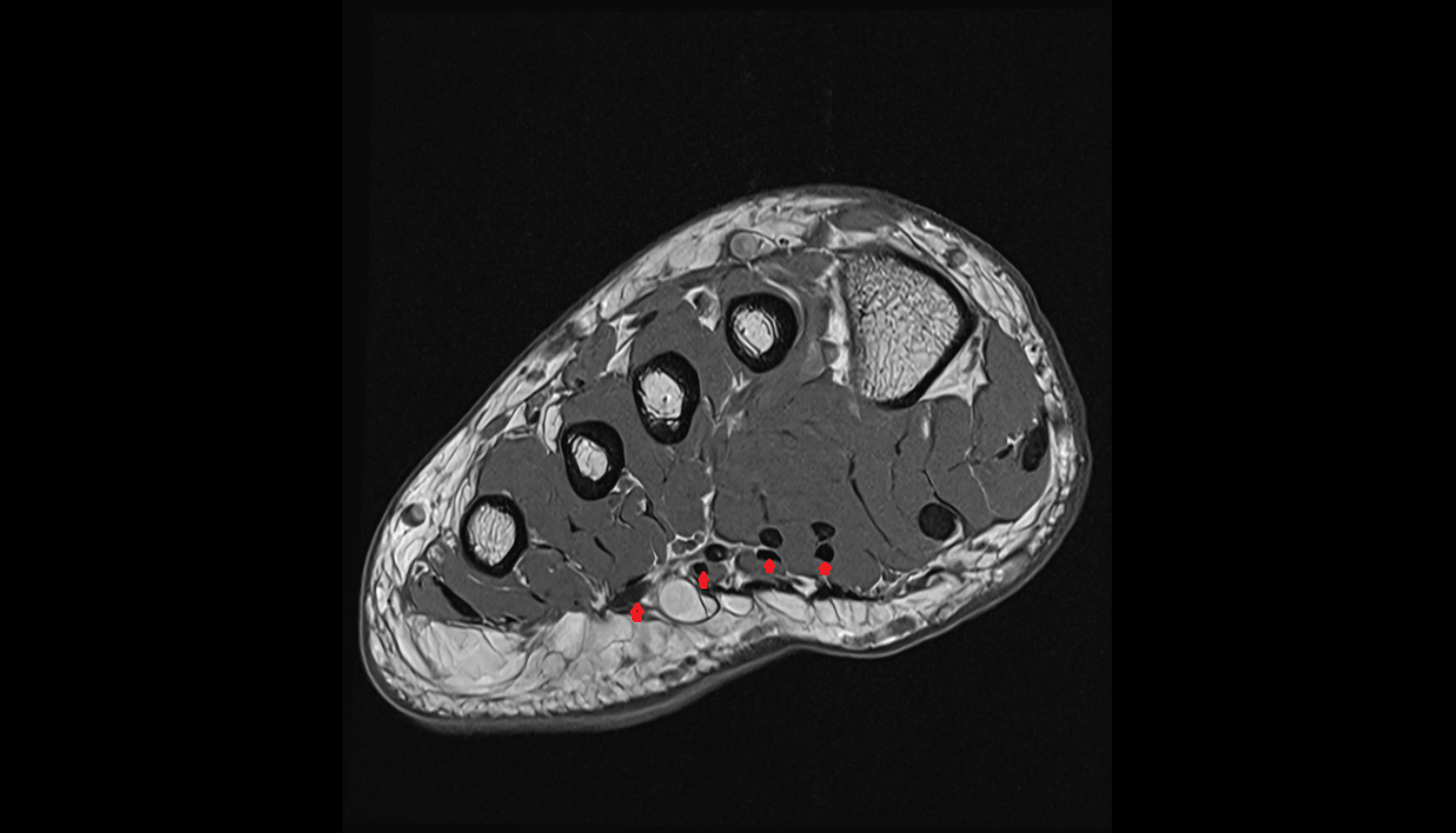 Flexor digitorum brevis tendons  of the Foot  axial cross sectional anatomy 3T MRI AI enhanced radiology image-img-00000-00000_00003